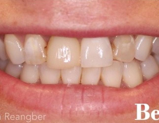 Porcelain Crowns and Veneers 2 before