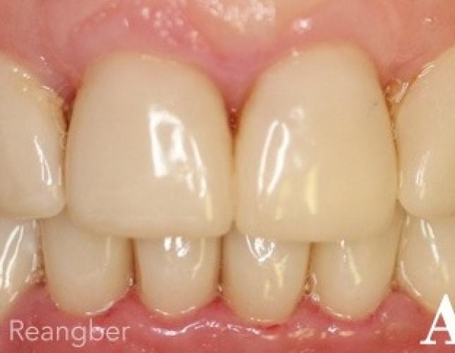 Porcelain Crowns on Lower Teeth to Match Upper Teeth after