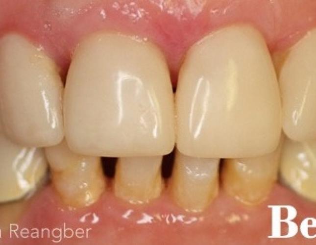Porcelain Crowns on Lower Teeth to Match Upper Teeth before