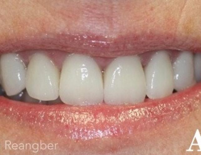 Porcelain Veneers 2 After