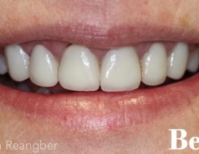 Porcelain Veneers 2 Before