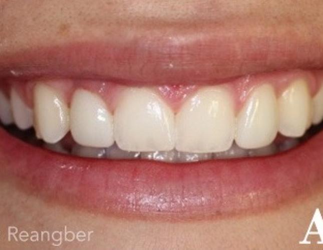 Porcelain Veneers 3 After