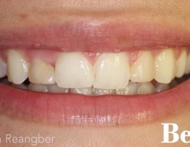 Porcelain Veneers 3 Before