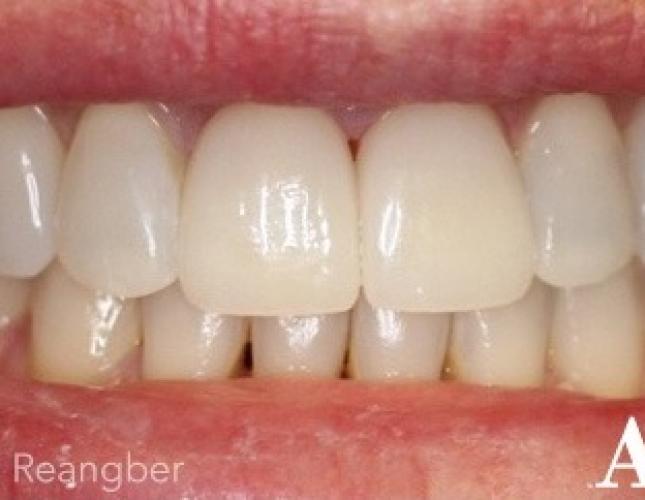 Porcelain Veneers 4 After