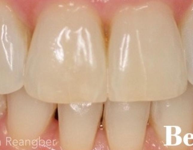 Porcelain Veneers 4 Before