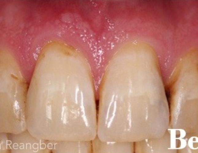 Porcelain Veneers 5 Before