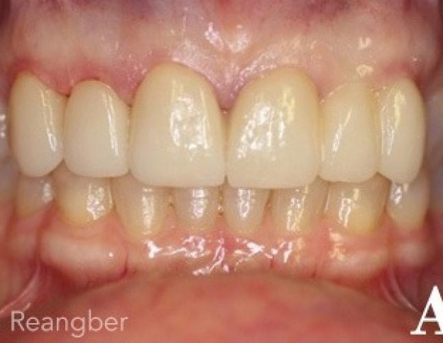 Porcelain Veneers and Crowns 2 after