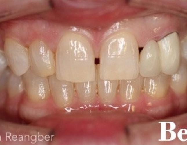 Porcelain Veneers and Crowns 2 before