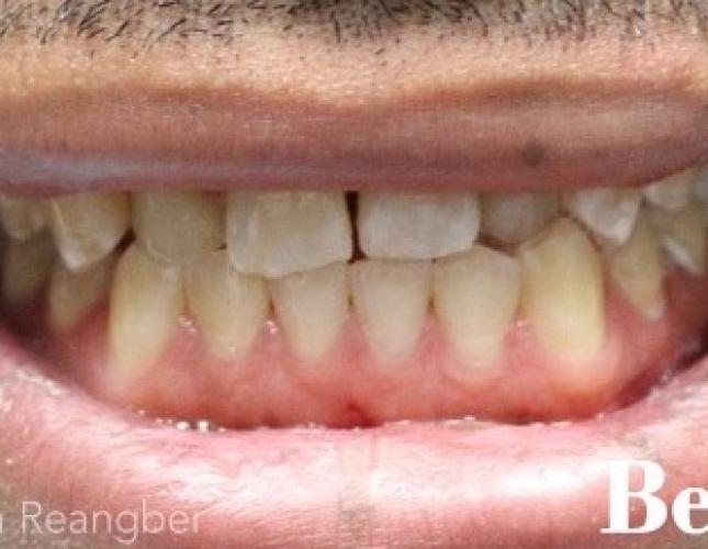 Porcelain Veneers and Crowns 3 before