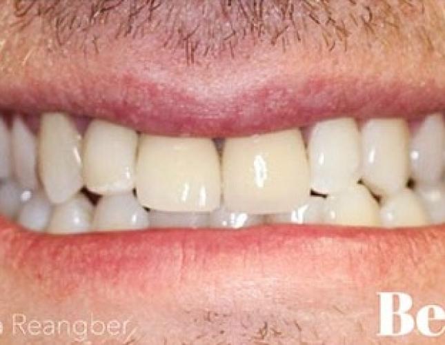 Porcelain Veneers and Crowns 4 before