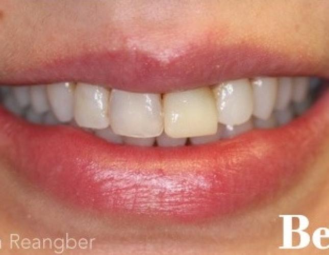 Porcelain Veneers 1 before
