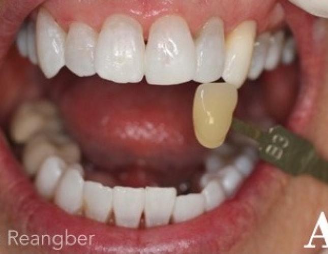 Tetracycline Stained Teeth Whitening After