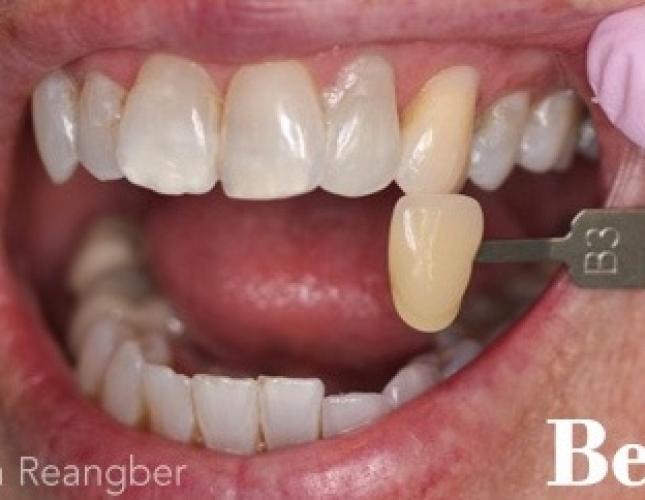Tetracycline Stained Teeth Whitening Before