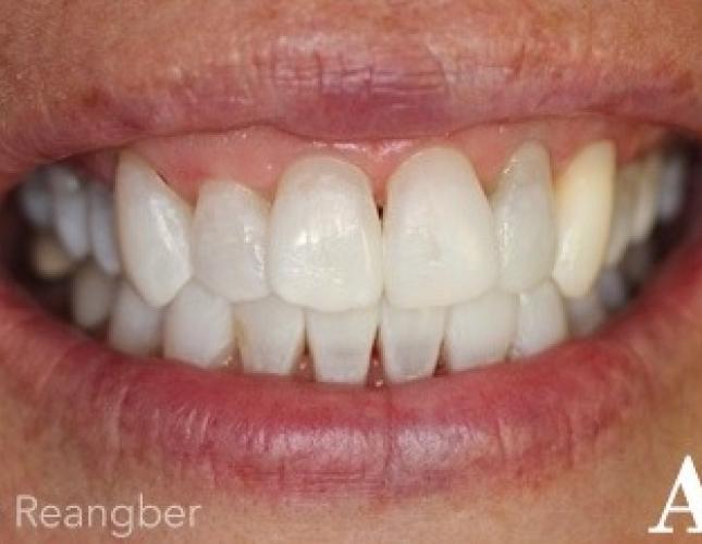 Tetracycline Stained Teeth Whitening 2 After