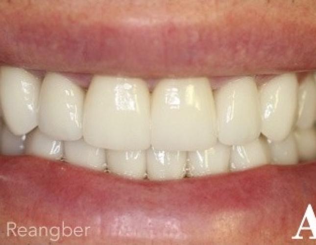 Porcelain Veneers 6 After
