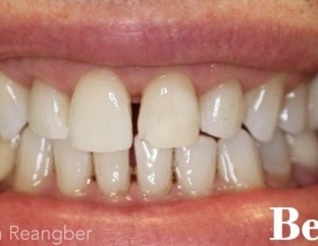 Porcelain Veneers 6 Before