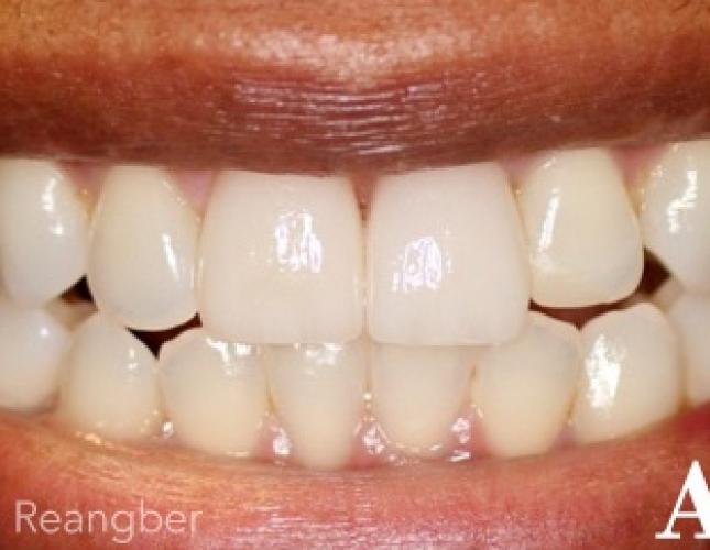 Whitening and Porcelain Crowns After