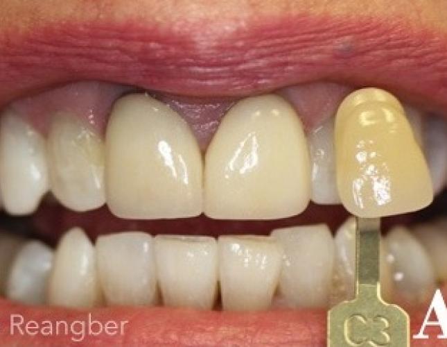 Whitening Tetracycline Stained After