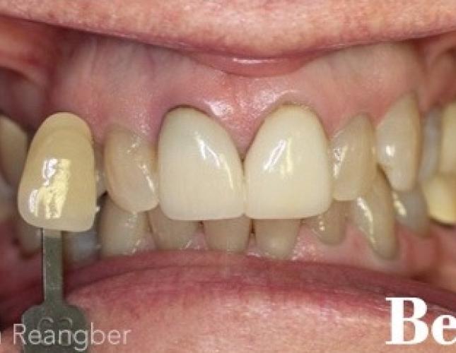 Whitening Tetracycline Stained Before
