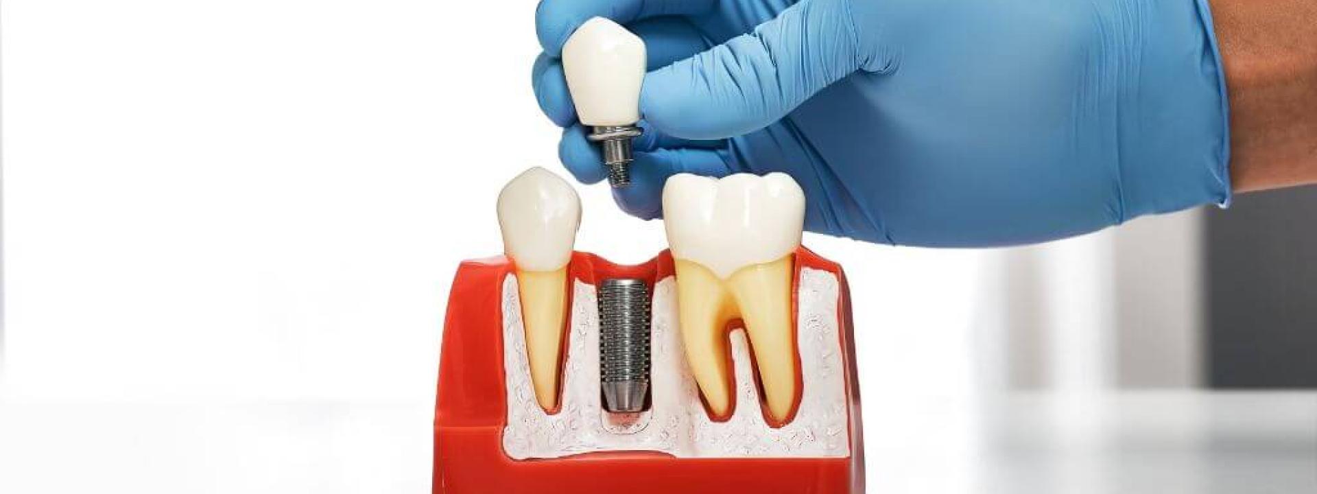 Complete dental implant model.