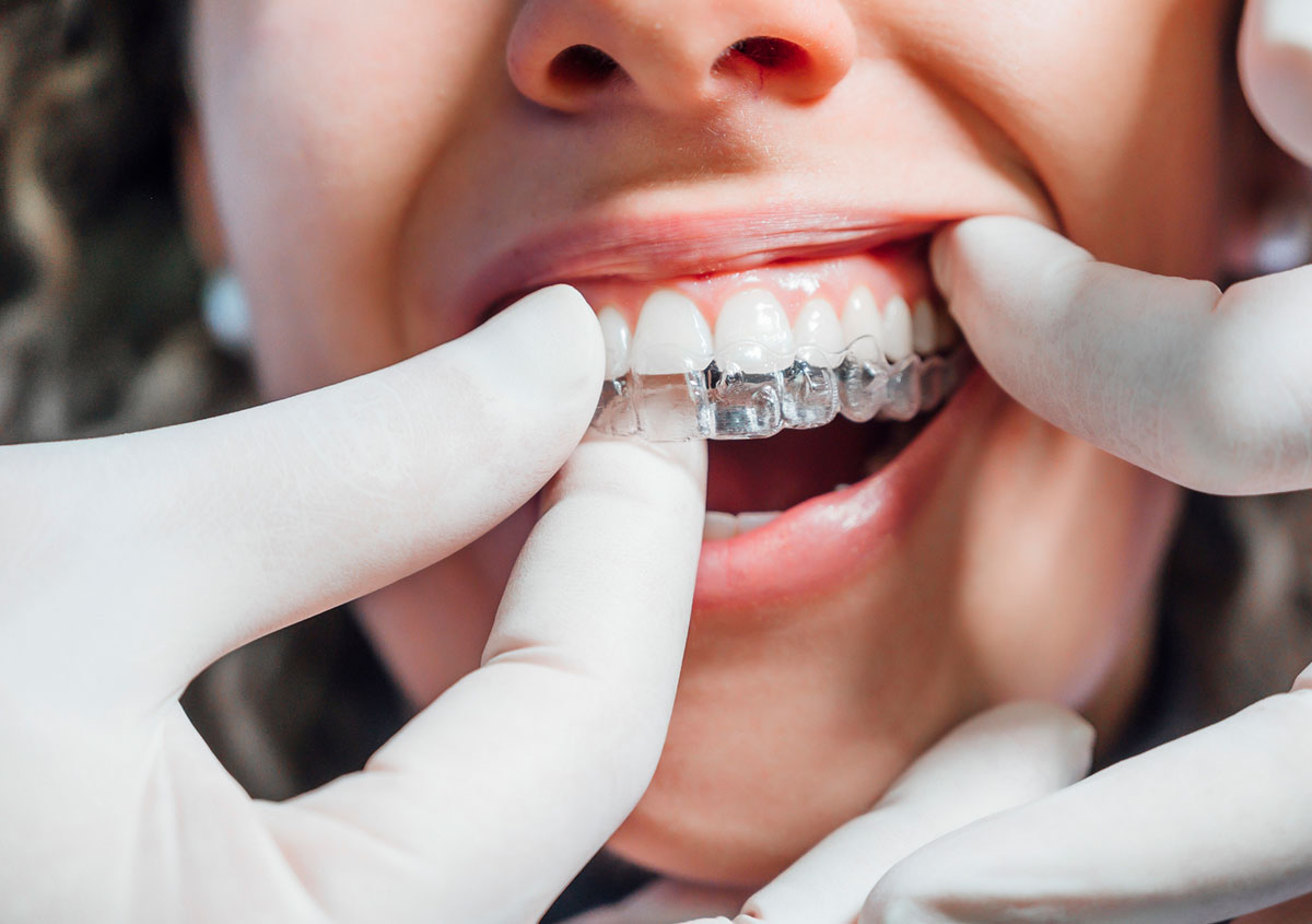 Orthodontics / Invisible / Clear Braces - Dr. Shukla's Dent Care