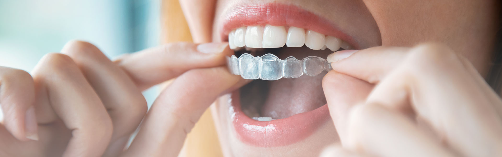 A woman is using clear aligners