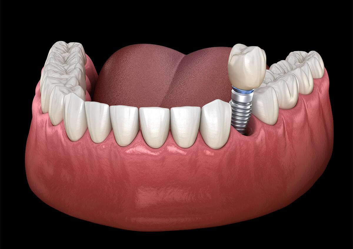Dental Implant Services in Haymarket VA Area